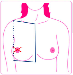 Locoregional cutaneous metastasis, defined as a lesion on the same side as the primary tumor located below the clavicle and above the rib margin and limited medially by the sternum and laterally by the posterior axillary line. Cutaneous metastases were defined as lesions outside these limits. Source: Lookingbill et al..19