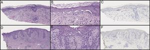 Initial biopsy showed diminished rete ridges and atypical cells in nests and as single cells with an underlying lymphohistiocytic infiltrate on hematoxylin and eosin (H&E) on low (A) and high (B) magnification. MART-1 showed weak staining of the lesional cells (C). Subsequent biopsies showed less nesting on H&E on low (D) and high (E) magnification and did not show a melanocytic neoplasm with SOX10 stains (F). Pankeratin and S100 were only focally positive (not pictured).