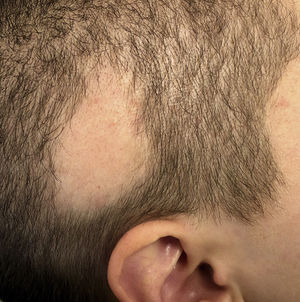 Alopecic plaque in the right temporal region with well-defined borders and a positive hair-pull test result.