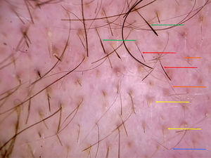 Image of the border of the alopecic plaque acquired using a DermLite II Hybrid dermatoscope (3Gen Inc., CA, USA). Red arrows, hairs with Pohl-Pinkus or monilethrix-like constrictions; green arrows, exclamation-mark hairs with a thickened distal end; yellow arrows, yellow dots; orange arrows, short vellus hairs; blue arrow, angulated hair.