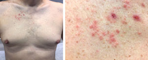 A, Erythematous and crusted papules on the chest. B, Image showing erythematous papules in greater detail.