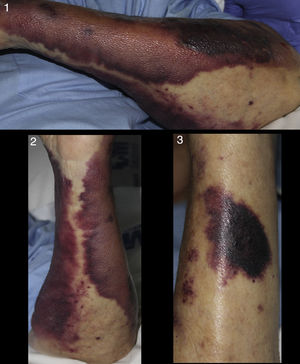 Extensive clearly defined and confluent purpuric macules with a few patchy and slightly raised plaques characterized by their darker color.