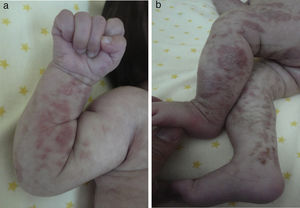 Blister-like erythematous lesions on the extremities corresponding to stage I disease (vesiculobullous lesions).