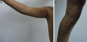 Hyperchromic macules corresponding to stage III disease (hyperpigmented lesions).