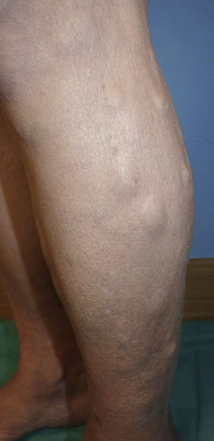 Multiple subcutaneous nodules covered by normal-colored skin on the legs.