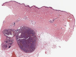 Skin biopsy of a lesion on the left leg. Panoramic view showing a well-circumscribed nodular lesion in the deep dermis and subcutaneous tissue (hematoxylin-eosin staining, original magnification ×2).