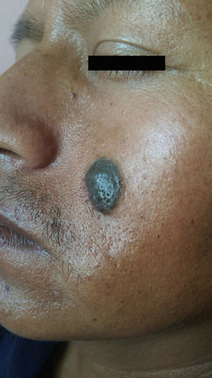 Black nodule with a diameter of 2 cm on the left cheek. Note the ill-defined borders and hair follicles.