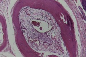 Spicule with megakaryocytes and white and red blood cell precursors in the yellow bone marrow. Hematoxylin-eosin, original magnification ×10.
