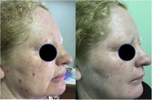 Field cancerization of the skin before and 6 months after DL-PDT session.