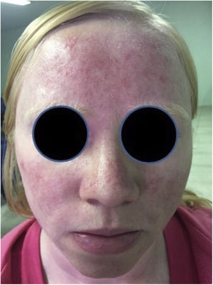 Moderate facial erythema immediately after the 2-hour outdoor exposition.