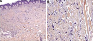 Multiple dermatofibromas. Histologic examination showing a cellular proliferation of spindled cells in the dermis, with overlying epidermal acanthosis (2a, H&E stain, x 40). Higher magnification shows that the spindle cells entrap normal dermal collagen bundles (2b, H&E stain, x 200).