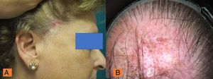 Atrophic plaques of alopecia with areas of erythema and inflammation in the temporal region. B, Red dots, white cicatricial patches, prominent branched capillaries (megacapillaries), and keratin plugs.