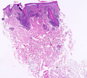 Hematoxylin and eosin stain×2, chronic inflammatory perifollicular and periadnexal infiltrate with vacuolar thickening and degeneration of the basal layer.