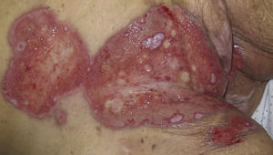 Case 1: Wide area of exudative ulcers with a fibrinous center and erythematous borders were observed around the vulva, in the groin, and over the lower abdomen.