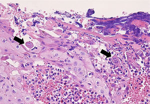 Histologic features in Case 2. The arrow on the left marks an epithelial cell with a gray nucleus and marginal chromatin. The same features can be seen in the multinucleated epithelial cell marked by the arrow on the right. (Hematoxylin-eosin; original magnification, ×400).