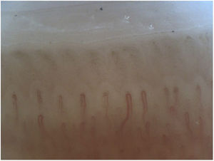 Normal pattern. Regular architecture with uniform distribution and diameter and hairpin or U shape.