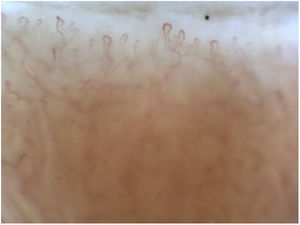 Systemic lupus erythematosus. Tortuous pattern with prominent superficial venous plexus.