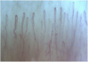 Rheumatoid arthritis. Nonspecific alterations: filiform, elongated loops, with a visible vascular plexus.