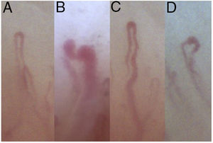 Individual capillary abnormalities. A, Normal capillary. B, Giant capillary. C, Regular ectasia. D, Irregular ectasia.