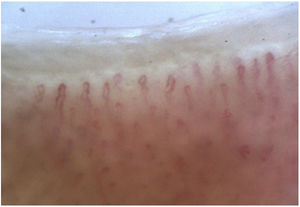 Tortuous pattern. Meandering capillaries; the afferent and efferent loops intersect at ≥2 points.