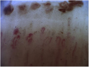 Active scleroderma pattern. Frequent giant capillaries, frequent microhemorrhages, and moderate capillary loss, with some disorganization of capillary architecture.