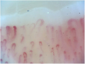 Mixed connective tissue disease. Giant, tortuous capillaries and avascular areas.