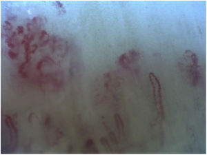 Dermatomyositis. Megacapillaries, bushy capillaries, and capillary loss with disorganization of the capillary array.