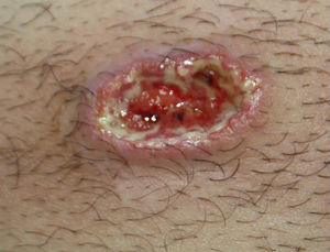 Ulcerated lesion measuring 3×1.5cm with an indurated violaceous border, a necrotic base, and a fibrinopurulent exudate at the right edge.