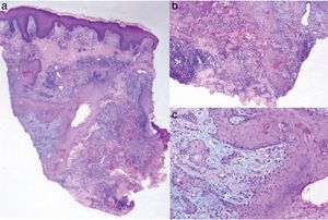 A, Epidermal hyperplasia with a pseudoepitheliomatous pattern and areas of necrosis in the dermis with a mixed inflammatory infiltrate (hematoxylin-eosin, original magnification ×4). B,C, Nests and squamous epithelium plaques in the dermis with central keratinization and discrete cellular atypia (hematoxylin-eosin, original magnification ×20).