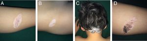 A, CMN showing loss of pigment and persistence of pigment in the central area. B, Achromic macule in the right iliac fossa. C, Occipital poliosis. D, Areas of repigmentation of the CMN 4 months after treatment. gr1.