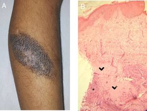 A, CMN with blackish-brown coloring and a whitish central area with a fibrotic appearance. Note the white hairs in this area. B, Histology: areas of collagen homogeneization (>) in the deep dermis, involving adnexa, surrounded by nevus cells and an inflammatory infiltrate (*). gr2.