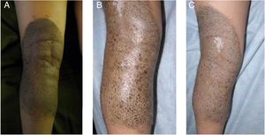 A, Medium CMN with small areas of regression. B, Follow-Up: note the progressive loss of pigmentation to follicular predominance. C. Detail of follicular atrophy. Note the unpigmented hairs. gr3.