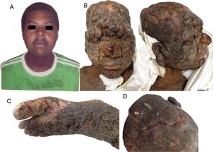 Clinical images of the patient: A, Image of the patient at 24 years of age, 4 years before the consultation. B, Photographs at the time of consultation, showing tumoral lesions on the face and scalp, associated with facies leonina. C, Severe involvement of the left foot. D, Involvement of the scalp with purulent exudate.