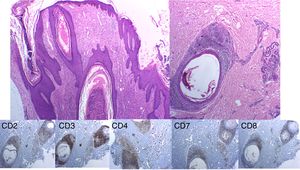 Histopathology images. Immune staining with hematoxylin–eosin shows a hyperplasic perifollicular epidermis with infiltration of the follicular epithelium by numerous lymphocytes, some of which are atypical. Immune staining and immunophenotyping of these lymphocytes shows CD3+, with partial loss of CD2 and CD7, and a CD4:CD8 ratio of 4:1.