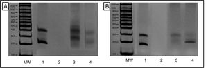 Evaluation of T-cell receptor gamma chain rearrangement using multiplex polymerase chain reaction (PCR). Results viewed in 6% polyacrylamide gel, in accordance with BIOMED-2 protocols. A, T Vγ1-8 and Vγ10 receptor cells. B, TCR Vγ9 and Vγ1. MW indicates molecular weight marker; 1, InVivoScribe «0021» positive control; 2, PCR mix and molecular biology grade water instead of DNA; 3, polyclonal control (pool of lymphocytes from healthy patients); and 4, Patient sample showing monoclonal product of approximately 200 nucleotides from the T-cell receptor regions Vγ9 and Vγ11.
