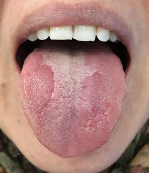 Erythematous plaques in absence of filiform papillae.