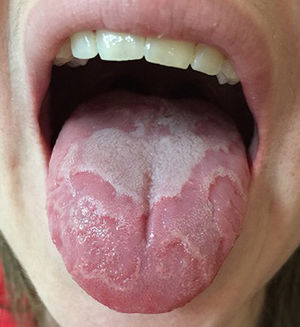 Erythematous plaques with a well-defined whitish margin on the dorsal of the tongue.