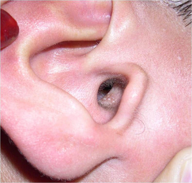 Vesicular Rash In Ear Recurrent Perimenstrual Vesicles Inside the Ear: A Rare Presentation ...
