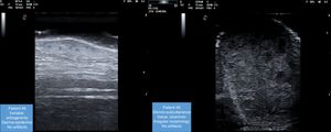 B-mode ultrasound findings of cutaneous metatases in patients #2 and #6.