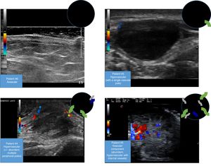 Doppler ultrasound patterns for patients in our series.