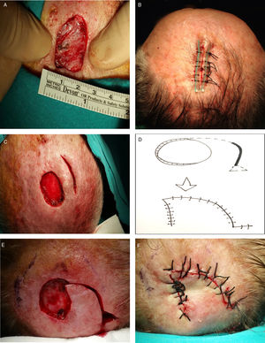 Reconstruction of defects with a minimum side-to-side distance less than 2cm after the skin was drawn together manually. A, Measuring the minimum achievable distance between sides. B, A probe-reinforced suture is recommended for distances less than 1cm. C, Defects measuring between 1and 2cm may require a release incision. D–F, If closure is still not possible, a rotation flap can be used.