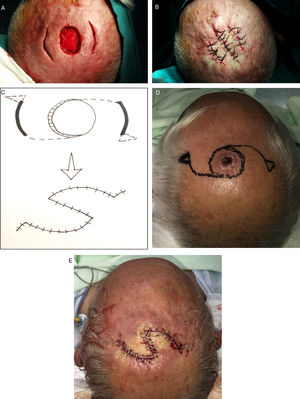 Reconstruction of defects with a minimum side-to-side distance of 2to 3cm after the skin was drawn together manually. A, Begin the process of closing these defects by making 2release incisions. B, After elevating the tissue, close with sutures. C–D, If that approach fails, design a double O-to-Z rotation flap. E, Close.