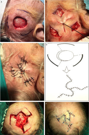 Reconstruction of defects with a minimum side-to-side distance of 3to 4cm after the skin was drawn together manually. A, Begin the process of closing these defects by making 3release incisions. B, Draw the skin together and secure with a single suture. C, Close the release incisions with a Mercedes flap. D–E, If a Mercedes flap cannot close the defect, prepare a triple Limberg flap. F, Close.