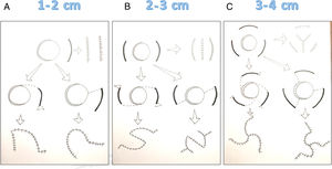 The 1–2–3 rule for reconstructing scalp defects. Reconstruction of defects with a minimum side-to-side distance of 1 to 2cm starts with a single release incision that can be extended to create a rotation or transposition flap if necessary. Reconstruction of defects with a minimum side-to-side distance of 2 to 3cm starts with 2 release incisions, which can be extended to create double rotation or transposition flaps. Reconstruction of defects with a minimum side-to-side distance of 3 to 4cm starts with 3 release incisions, which can be extended to provide triple rotation or transposition flaps if necessary.