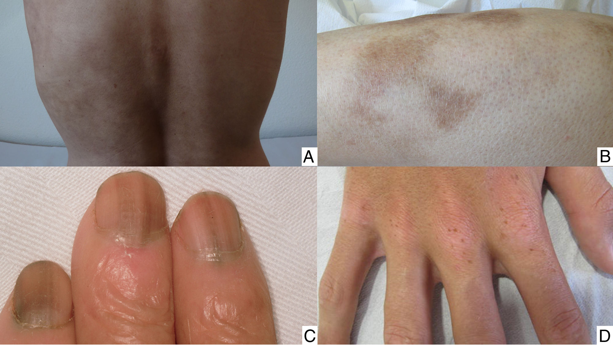 Delayed Chemo Rash Clinical Management of Cutaneous Adverse Events in Patients on ...