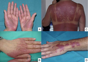 A) Chemotherapy-induced acral erythema; B) Chemotherapy-induced acral erythema with atypical distribution on the dorsum of the hands; C) Sunburn recall reaction; D) Localized epidermal necrolysis at the injection site.