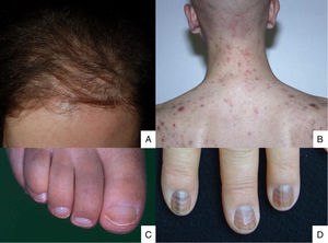 A) Post-chemotherapy alopecia is diffuse, appears in the first few weeks of treatment, and spares the hairline; B) Folliculitis after dactinomycin administration; C) Half-and-half nails; D) Muehrcke's lines with diffuse pigmentation after cyclophosphamide administration.