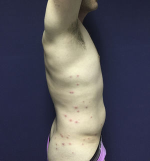 Papules and pustules surrounded by an erythematous halo on the side of the thorax, abdomen, and buttocks.