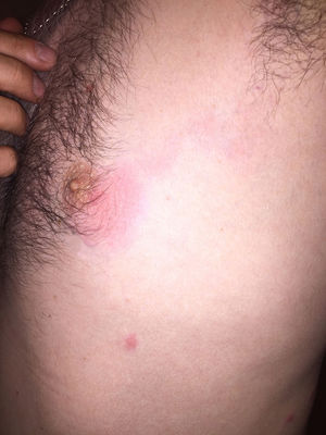 Serpiginous erythematous macular lesion with poorly defined borders extending from the left periareolar region towards the left axilla, where a mobile and sensitive inflammatory lymph node of 1.5 cm was palpable.