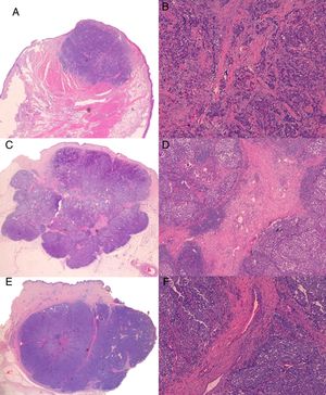 A, Case 1: Lesion with solid growth pattern and slightly spiculated margins (hematoxylin-eosin [H-E); B, Detail of fibrous trabeculae in the form of fine bands with scant vascular structures (H-E, original magnification ×100); C (case 3), Tumor with clearer margins and a lobular structure with fibrous bands that appear to correspond to the hyperechogenic intralesional lines observed by B-mode ultrasound (H-E); D, Detail of thick fibrous bands containing numerous vascular structures (H-E, original magnification ×40); E (case 4), Lobular lesion with a thick fibrous band perpendicular to the epidermis that appears to correspond to the hypoechoic line detected by B mode ultrasound; F, Detail of thick central fibrous band with wider vascular structures than in case 3 (H-E, original magnification ×100).